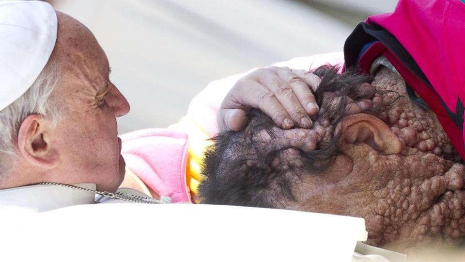 Pope Francis embraces a man with neurofibromatosis at his weekly audience. November 6, 2013. Credit: EPA