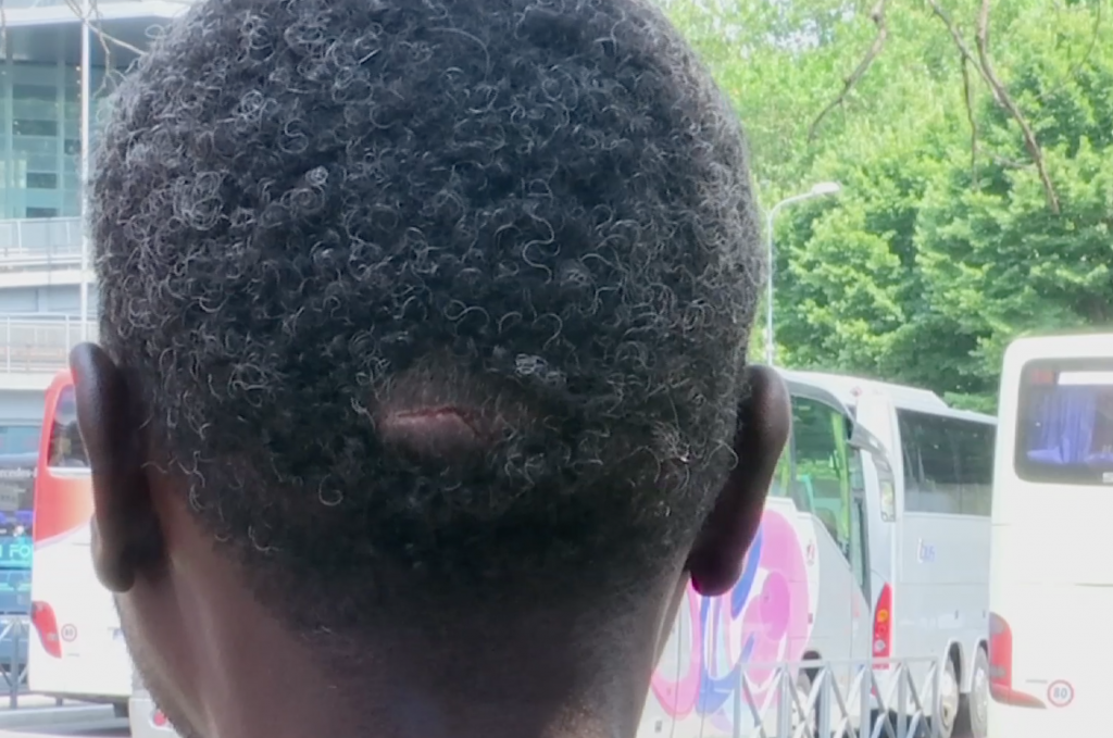 Gash on the back of the head of Abdul Aziz, migrant from Darfur, Sudan who said he was hit by an ISIS fighter with a rifle butt for refusing to hand over his cell phone. Freeze frame of video shot by AP Television Cameraman Luigi Navarra. June 11, 2015