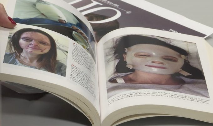Lucia Annibali shows us photos of herself from the period when she was in the hospital following an acid attack. The photos are in her book "I Am Still Here: My Story of Not Love." Freeze frame of video shot by Paolo Santalucia, February 21, 2017